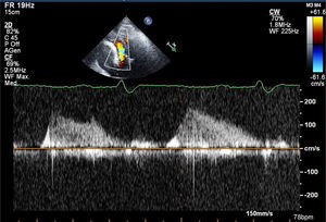 Transthoracic echocardiography, continuous-wave Doppler on the tricuspid valve, showing severe functional valve stenosis.