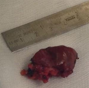 The mass as seen after surgical removal.