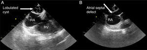 Transesophageal echocardiographic views showing (A) lobulated cyst and (B) atrial septal defect. RA: right atrium; RV: right ventricle.