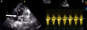 Transthoracic echocardiographic views showing (A) multiple cystic mass compressing the pulmonary artery and (B) continuous wave Doppler of the pulmonary artery with maximum gradient of 40 mmHg. PA: pulmonary artery.