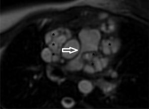 Cardiac magnetic resonance imaging showing external compression of pulmonary artery. Black asterisks indicate hydatid cysts.