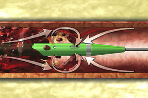 Diagram of the AngioJet® catheter with its dual lumen, an intake lumen through which a high-pressure saline jet is pumped and an exhaust lumen through which the thrombus is removed. Three orifices in the catheter tip enable three high-pressure jets to form towards the exhaust lumen, which creates a pressure gradient to fragment and aspirate the thrombus.