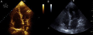 (A) Transthoracic echocardiogram in apical 4-chamber view in the emergency room revealing marked dilatation of the right chambers and straightening of the ventricular septum; (B) transthoracic echocardiogram one month after discharge showing no significant abnormalities.
