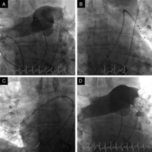 Fluoroscopic images during initial arteriography of the pulmonary trunk (more selective for the right pulmonary artery), showing massive bilateral pulmonary embolism with thrombi in the main pulmonary arteries and involving all the lobar arteries, with significant flow obstruction (A); 6F AngioJet® catheter positioned in the left pulmonary artery (B) and in the right pulmonary artery (C); final image, demonstrating slight angiographic improvement but with immediate improvement in hemodynamics and gas exchange (D).