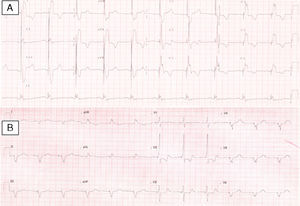 12-lead electrocardiogram before (A) and after (B) implantation of a biventricular pacing system, showing right axis deviation and reduction of QRS interval from 196 to 144 ms.