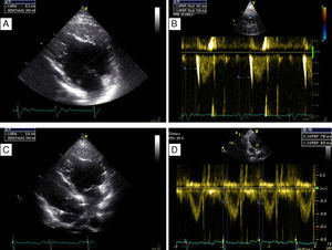 Transthoracic echocardiogram before (A and B) and after (C and D) implantation of a biventricular pacing system, showing decrease in diastolic systemic ventricular size (a possible indicator of reverse remodeling) from 63 mm (A) to 58 mm (C), and disappearance of systemic electromechanical delay as quantified by pre-ejection time falling from 161 ms (B) to 83 ms (D).