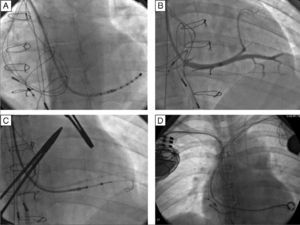 Implantation of a cardiac resynchronization system via the right subclavian vein in a patient with a DDDR pacemaker in the left heart. (A) Catheterization of the coronary sinus with a diagnostic catheter followed by introduction of a guide catheter; (B) venography of the coronary sinus, showing two tributary veins suitable for delivery of the systemic ventricular pacing lead; (C) introduction of a guidewire through the catheter in the posterolateral vein followed by introduction of the systemic ventricular pacing lead; (D) final result following implantation of the resynchronization system, with leads in the right atrium, pulmonary vein and systemic ventricle.