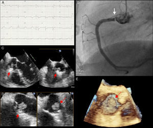 Diagnostic exams performed during the investigation of this case: (A) initial electrocardiogram showing ST-segment elevation in the inferior leads; (B) right coronary angiography showing interruption of contrast (arrow) in the ostium; (C and D) transesophageal echocardiogram of the tumor (dashed arrow) showing its location and relation to the stent (solid arrow) in the right coronary artery; (E) three-dimensional transesophageal echocardiogram of the tumor (dashed arrow).