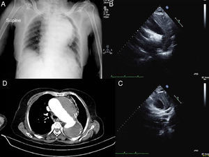 Chest X-ray showing marked mediastinal enlargement (A); transthoracic echocardiogram, suprasternal view (B) and short-axis view (C), showing aneurysm of the aortic arch and the proximal portion of the descending aorta, with what appears to be a large organized mural thrombus; and thoracic computed tomography angiography (D) showing an aneurysm of the aortic arch and descending aorta, maximum diameter 7 cm, and a large mural thrombus, without signs of acute aortic syndrome.