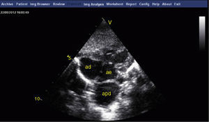 Transthoracic echocardiogram, subcostal 4-chamber view, showing the right pulmonary artery compressing the left atrium. ad: right atrium; ae: left atrium; apd: right pulmonary artery.