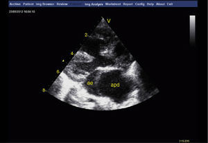 Transthoracic echocardiogram, parasternal long-axis view, showing perimembranous ventricular septal defect and overriding aorta (50%), and aneurysmal dilatation of the right pulmonary artery compressing the left atrium. ae: left atrium; apd: right pulmonary artery.