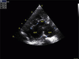 Transthoracic echocardiogram, parasternal short-axis view, showing aneurysmal dilatation of the pulmonary artery trunk (15 mm) and left (22 mm) and right (25 mm) branches. apd: right pulmonary artery; ape: left pulmonary artery; apt: pulmonary artery trunk.