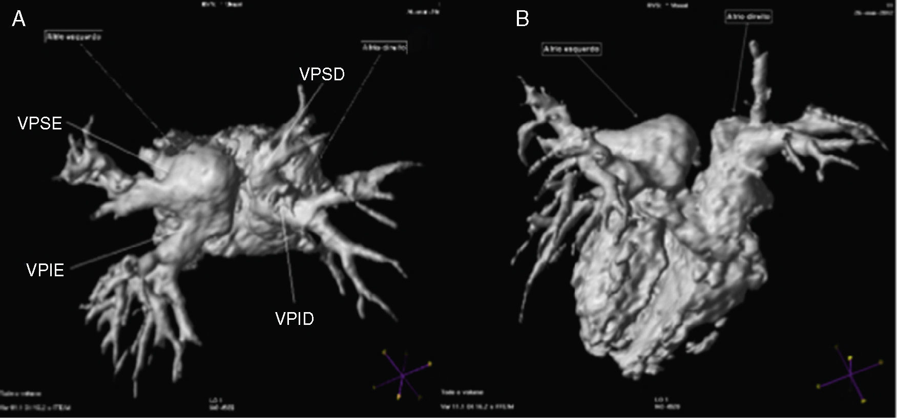 Vpsd Anomalous pulmonary venous return in a pregnant woman identified by ...