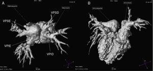 Magnetic resonance angiography of the pulmonary veins: three-dimensional images in superior (A) and posterior (B) views, confirming partial anomalous pulmonary venous return, with two pulmonary veins draining into each atrium. VPID: right inferior pulmonary vein; VPIE: left inferior pulmonary vein; VPSD: right superior pulmonary vein; VPSE: left superior pulmonary vein.
