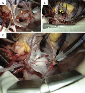 Surgical repair of partial anomalous pulmonary venous return: confirmation of anomalous drainage of the right pulmonary veins into the right atrium, with intact atrial septum. (A) Right pulmonary veins draining into the right atrium, with no atrial septal defect. Red arrow: venous coronary sinus; yellow arrow: fossa oval, intact atrial septum; (B) atrial septum opened surgically, showing left atrium and left pulmonary veins. Black arrows: right pulmonary veins; yellow arrows: left pulmonary veins; (C) correction complete, with a bovine pericardial patch directing right pulmonary venous flow into the left atrium.