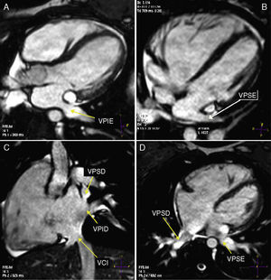 Cardiac magnetic resonance cine sequences, showing both left pulmonary veins draining into the left atrium (A and B) and both right pulmonary veins draining into the right atrium (C and D). VCI: inferior vena cava; VPID: right inferior pulmonary vein; VPIE: left inferior pulmonary vein; VPSD: right superior pulmonary vein; VPSE: left superior pulmonary vein.
