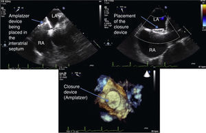 Transesophageal echocardiogram during placement of the Amplatzer septal occluder device in the interatrial septum. The bottom picture is in 3D. LA: left atrium; RA: right atrium.