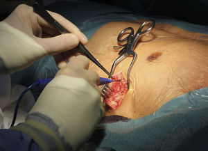 Site of the generator pocket at the left mid-axillary line in the vicinity of the sixth intercostal space.