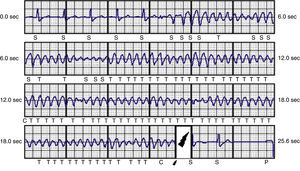 Electrogram showing an appropriate therapy for ventricular tachycardia in a patient with ischemic heart disease.