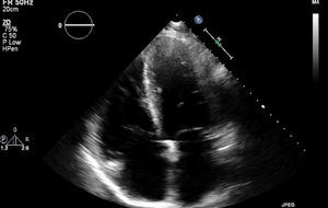 Echocardiography in apical 4-chamber view showing dilatation of both atria and the right ventricle.