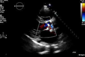 Echocardiography in long-axis parasternal view showing thickened and calcified aortic valve with significantly limited opening.