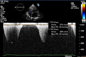 Echocardiography showing mild to moderate tricuspid regurgitation.