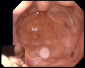 Endoscopy showing gastrointestinal angiodysplasias.
