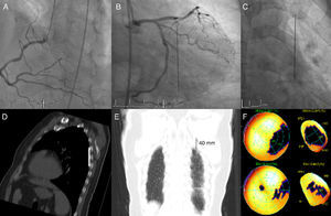 (A) Right coronary artery in left anterior oblique projection at 45°, caudal 10°, showing 60% proximal stenosis and 70% stenosis in the posterolateral branch; (B) left coronary artery in right anterior oblique projection at 30°, caudal 10°, showing no significant lesions but revealing a sewing needle in the left hemithorax; (C) anteroposterior view, 0° 0°, showing magnified image of the needle; (D) thoracic computed tomography (CT), sagittal plane, showing the needle in subpleural position, posterior to the apical segment of the left inferior lobe; (E) thoracic CT, pulmonary window, coronal plane, showing the needle, 40 mm in length, in cranial-caudal orientation; (F) myocardial scintigraphy: after exercise (above) and at rest (below), documenting a lateral perfusion defect with significant reversibility.