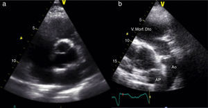 Transthoracic echocardiography: (a) anatomically normal image in parasternal short-axis view; (b) parasternal short-axis view showing parallel great vessels and morphologically right ventricle in anterior position in continuity with the aorta, also in anterior position (Video 1). Ao: aorta; AP: pulmonary artery; V. Morf. Dto: morphologically right ventricle.