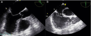 Transesophageal echocardiography: (a) anatomically normal image; (b) corresponding image showing absence of continuity between the aortic valve and left atrioventricular (morphologically tricuspid) valve through an infundibulum (asterisk); morphologically right ventricle in left position and aortic valve in normal continuity with systemic circulation (aorta) (Video 2). V Ao: aortic valve; V.AV Esq: atrioventricular valve in left position.