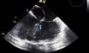 Transesophageal echocardiography showing insertion of the atrioventricular valves in the same plane (arrow), consistent with congenitally corrected transposition of the great vessels and atrioventricular septal defect, an association that occurs in 75% of cases2 (Video 3).