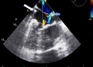 Transesophageal echocardiography showing right atrium receiving two venae cavae; morphologically mitral atrioventricular valve in right position; lead (white arrow) identifying the superior vena cava and morphologically left ventricle in right position; atrial septal defect with residual low shunt (blue arrow) (Videos 4 and 5).