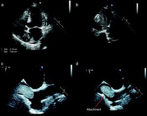 (a) Transthoracic echocardiography, apical 4-chamber view, showing a homogenous ovoid mass; (b) transthoracic echocardiography, subcostal view, showing the mass extending from the inferior vena cava to the right atrium; (c) transesophageal echocardiography, off-axis bicaval view, showing invasion of the inferior vena cava; (d) transesophageal echocardiography, bicaval view, showing the thin attachment of the mass to the right atrial inferoposterior wall.