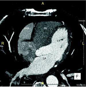 Computed tomography (CT) scan, axial view. LA: left atrium; LV: left ventricle; RA: right atrium; RAA: right atrial aneurysm; RV: right ventricle.
