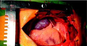 Intraoperative photograph (surgeon's view) revealing the right atrial aneurysm (RAA).