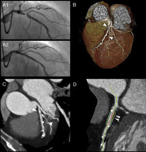 Coronary angiography, showing significant left anterior descending stenosis (A1) and angiographic outcome after placement of a bioabsorbable scaffold (A2). Multislice computed tomography angiography: volume rendering (B) and maximum intensity projection reconstructions (C), revealing the radiopaque indicators (arrows) at the edges of the scaffold. Virtual histology technique showing the non-calcified atherosclerotic plaque (arrows) excluded by the stent (D).