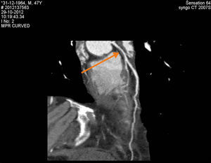 Computed tomography angiography showing significant plaque in the distal left main artery.