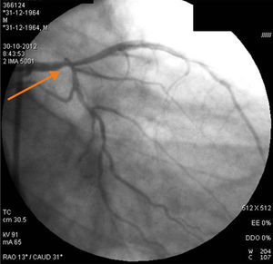 Invasive coronary angiography showing significant plaque in the left main artery.
