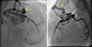 Angiographic image of the fistula (yellow arrow) arising from the proximal segment of the anterior descending artery and draining into the pulmonary artery. Left: right oblique cranial view; right: lateral view.