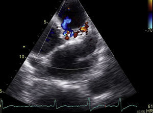 Transthoracic echocardiogram, parasternal short-axis view, with color Doppler applied to the course of the left main/anterior descending artery, showing multiple areas of turbulent flow corresponding to branching of the fistula at this point.