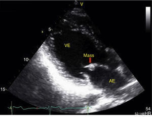 Transthoracic echocardiogram in parasternal long-axis view, showing a small, well-defined mass adhering to the anterior leaflet of the mitral valve. AE: left atrium; VE: left ventricle.