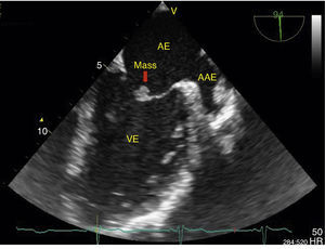 Transesophageal echocardiogram in long-axis view, showing an echodense pedunculated mass adhering to the atrial face of the anterior mitral valve leaflet. The left atrial appendage can also be seen, with no evidence of thrombus. AAE: left atrial appendage; AE: left atrium; VE: left ventricle.