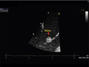 Transesophageal echocardiogram in long-axis view, with magnification of the area of interest, showing an echodense mass 0.5 cm2 in size adhering to the anterior leaflet of the mitral valve.
