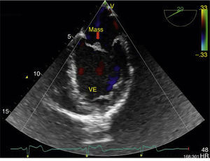 Transesophageal echocardiogram in long-axis view, color Doppler, showing the mass adhering to the mitral valve but no significant mitral regurgitation. VE: left ventricle.