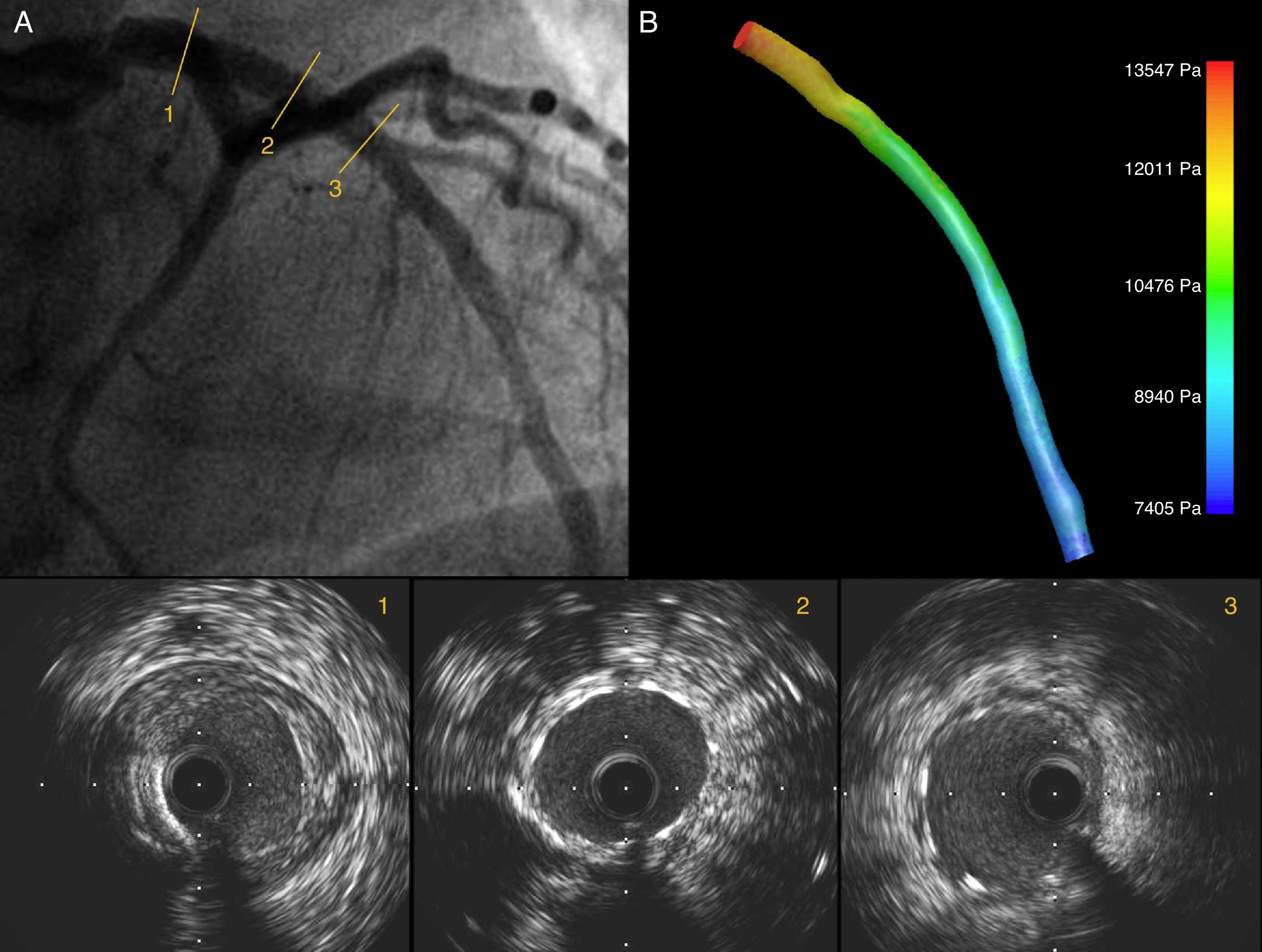Functional assessment of coronary artery disease by intravascular ...