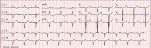 12-lead electrocardiogram depicting poor R-wave progression in the precordial leads and a pseudo-infarct pattern in the inferior leads.