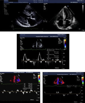 Transthoracic echocardiogram, parasternal long-axis (A) and 4-chamber (B) views, showing biventricular hypertrophy (interventricular septum 21 mm; posterior wall 19 mm), increased thickness of the interatrial septum, biatrial enlargement (left atrial indexed volume 42 ml/m2) and mild circumferential pericardial effusion. Diastolic assessment shows a restrictive pattern: transmitral flow (C) with E/A ratio >2 and deceleration time <150 msec; decreased tissue Doppler (D and E) E′ velocities (lateral E′: 4.6 cm/s; septal E′: 2.8 cm/s) and increased E/E′ (mean E/E′ ratio: 25). Decreased myocardial velocities on pulse-wave Doppler (lateral S′: 3.7 cm/s, septal S′: 3.3 cm/s) can also be observed (D and E).
