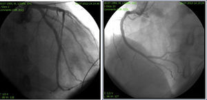 Coronary angiography of the left and right coronary circulation showed no significant disease.