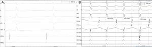 Electrocardiographic tracings during sinus rhythm (A) and atrial tachycardia (B). Variability of ventricular activity duration and the first atrial activity seen on proximal coronary sinus recordings indicate left atrial tachycardia (B). Recording speed 150 mm/s, tachycardia cycle length 420 ms.