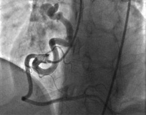 A giant coronary fistula originating from the proximal portion of the right coronary artery and draining into the right atrium, seen on the angiogram, left anterior oblique cranial view.